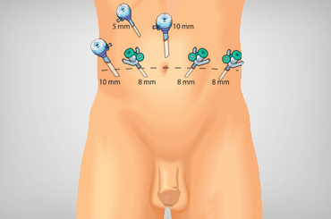 Bone cancer